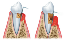 歯周病進行の様子